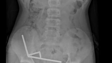 نیوزی لینڈ: ڈاکٹروں نے لڑکے کے پیٹ سے 100 مقناطیس نکال دیے/ اردو ورثہ