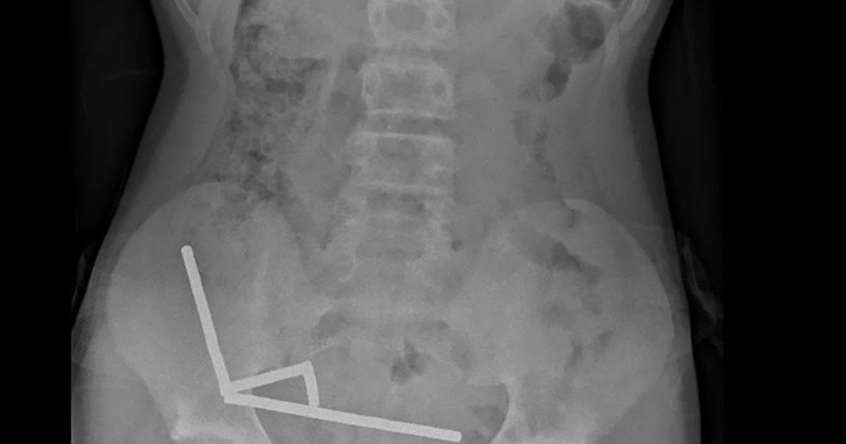 نیوزی لینڈ: ڈاکٹروں نے لڑکے کے پیٹ سے 100 مقناطیس نکال دیے