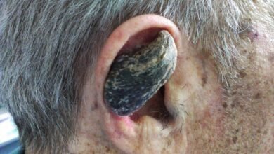 کچھ انسانوں کے سینگ کیوں اُگ آتے ہیں؟/ اردو ورثہ