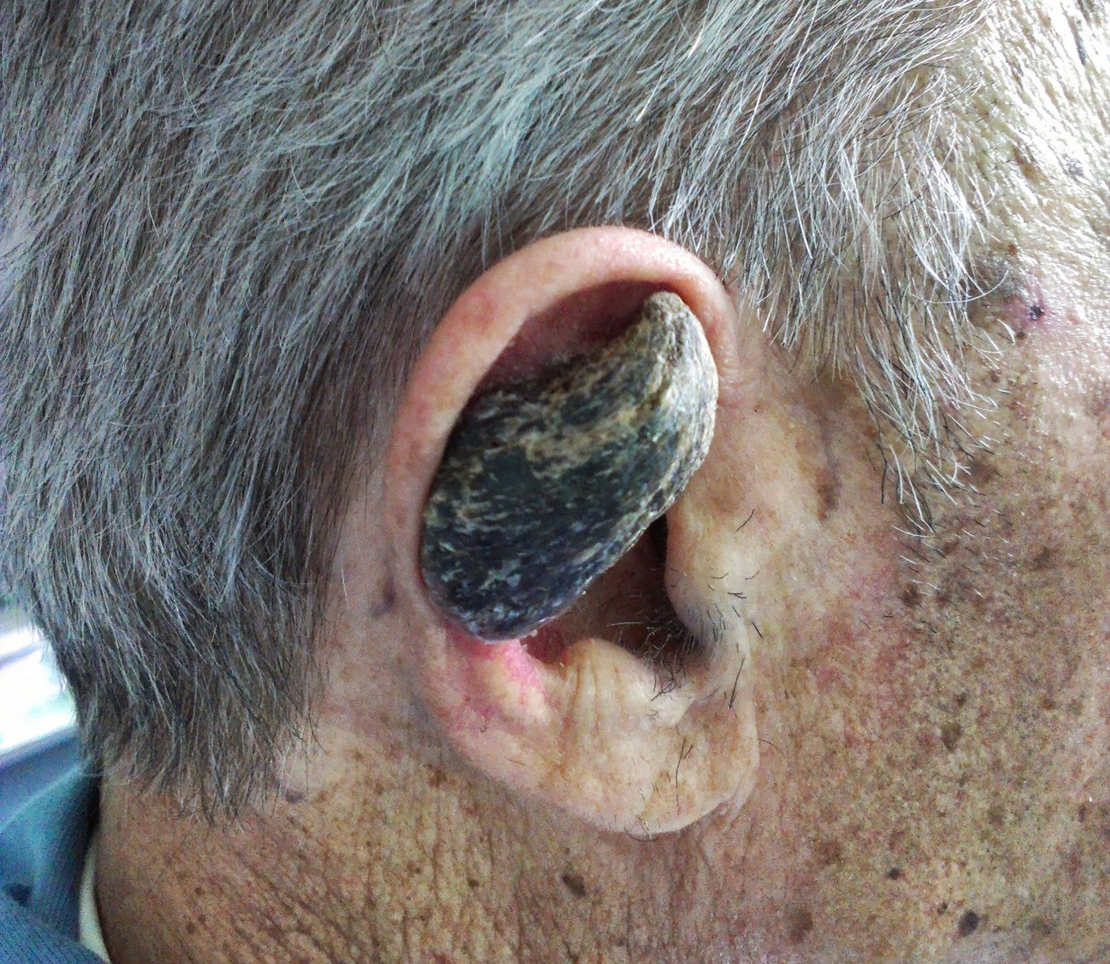 Here’s the reason why some humans grow horns